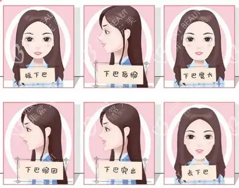 垫下巴10个垫9个取?下巴千万不要做假体是真是假?