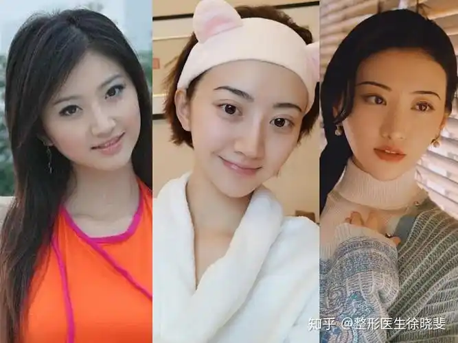 肌肉重新缝合固定,达到正常的眼部结构层次修复出的双眼皮才会自然,不