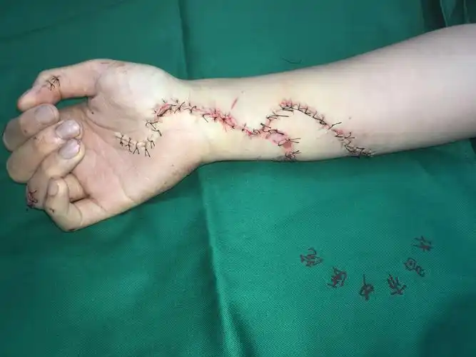 骨伤科 前臂切割伤手术1例