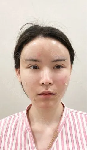 终于做了脂肪填充了,心里的大石头可以放下了.