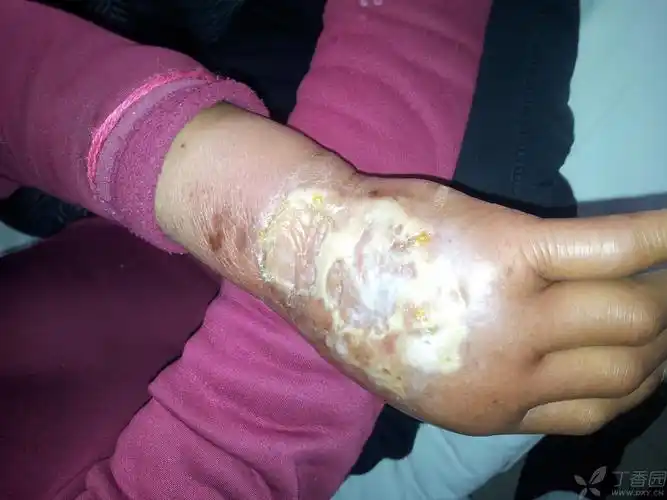 【请教】盐酸表柔比星外渗引起皮肤损害的求助