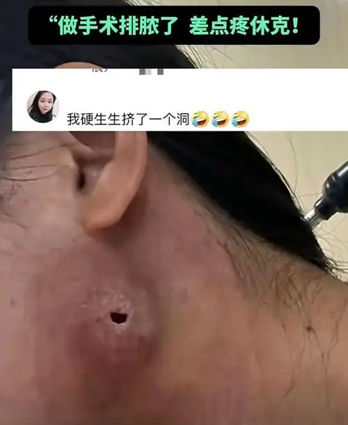女子脖子上长了巨型火疖子,越长越大排脓后留下一个洞