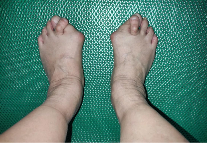 原来她的踇趾有点向外偏斜,也就是拇外翻,俗称"大脚骨"