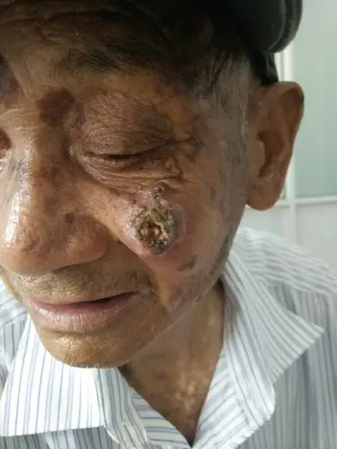 面部肿瘤 - 皮肤与性传播疾病讨论版 -丁香园论坛