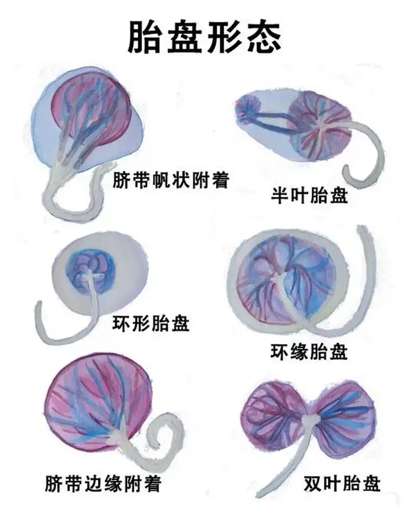 形状各异的胎盘,有的要格外小心哦 胎盘是胎儿与母体营养物质交换的
