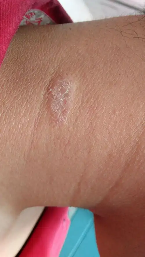 脖子上长得一块,只有夏天在出来,什么某种癣还是什么?有害么?