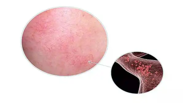 角质层增厚小妙招