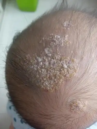 时间长了会出现问题,我家宝宝头上最后感染了,成了脂溢性皮炎,尽快