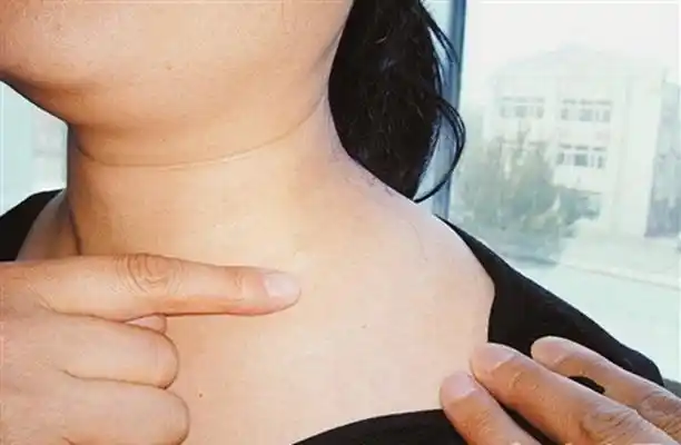 武汉淋巴结肿大专家_武汉治疗淋巴结肿大哪个专家好_武汉治疗淋巴结