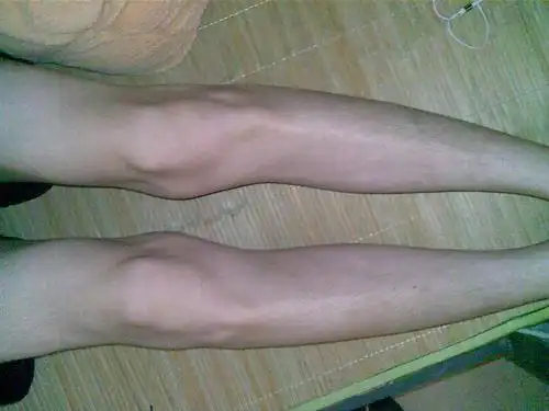 人太瘦站直膝盖间有缝隙是o型腿吗?