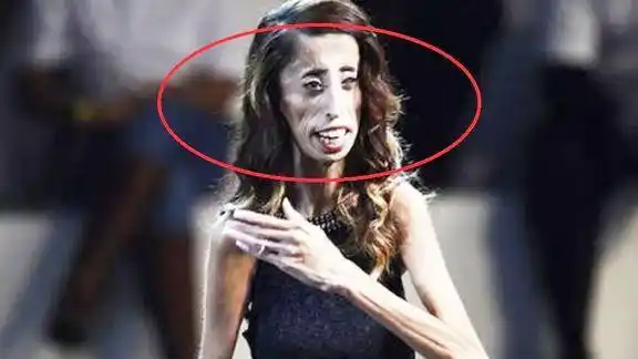 俄罗斯女子体重只有40斤成为世界上最瘦的人丈夫仍然不离不弃