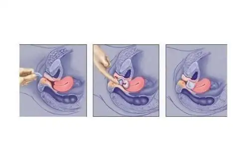 臭氧联合阴道塞药治疗门诊阴道炎的效果论文