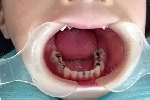 儿童口腔展示图