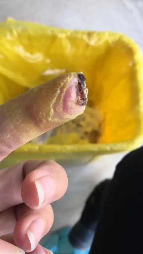 手指尖上的肉被超声波烫压坏死,时间长不去掉会感染骨头坏死吗?