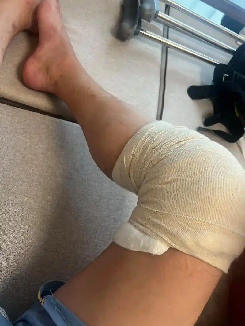 半月板缝合第二天,弯曲可以到90度(医生不让超过90度)