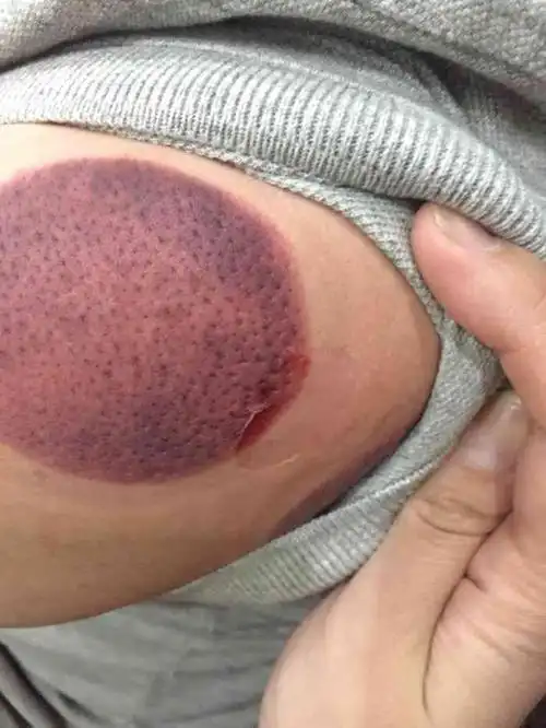 打分 拔罐把男友的肩部弄出了大水泡,破皮半个月也没好.