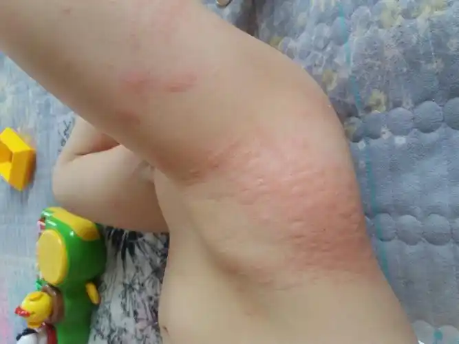 宝宝得了过敏荨麻疹?怎么办?有没有好的办法,可以治疗的快点!很着急!