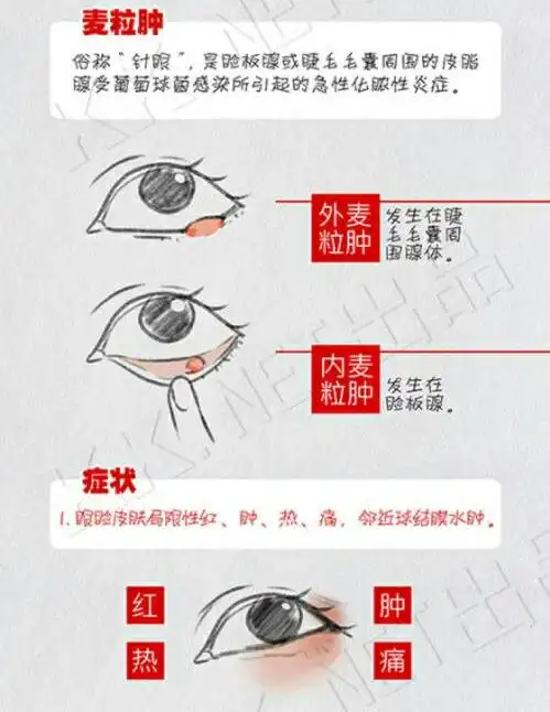 许昌市人民医院眼科:孩子为什么老得麦粒肿呢?