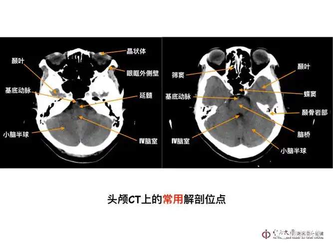 超实用急诊头颅ct3b阅片法