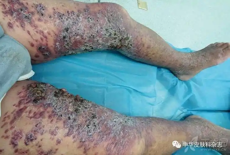 溃烂的双腿,这还能治吗? - 皮肤与性传播疾病讨论版 -丁香园论坛