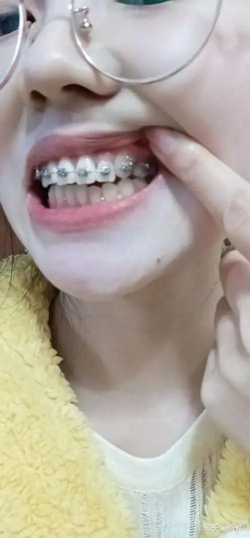 9.30虎牙矫正记录 - 知乎