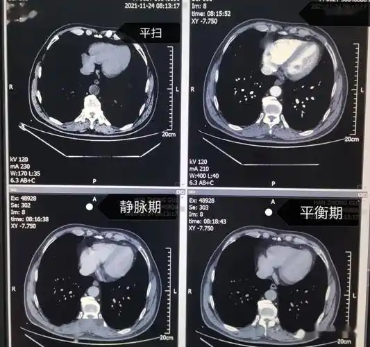 图片是患者ct平扫和多期增强扫描(动脉期,静脉期,平衡期或延迟期)的