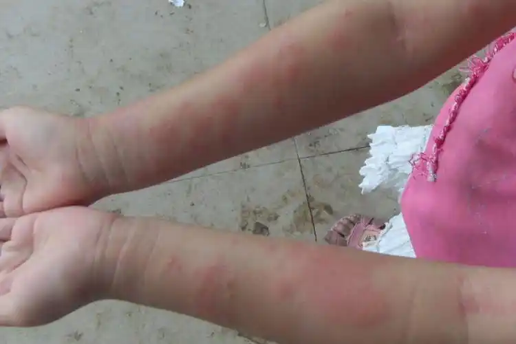 手部过敏性皮炎在治疗首先是脱离过敏原,采取针对过敏症状的治疗,如