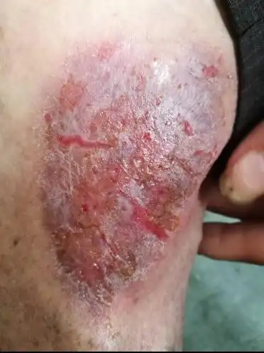 小腿皮肤溃烂严重,有什么偏方可以治愈吗?