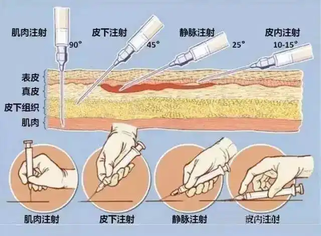 7,无痛注射穿刺方法皮肤痛觉神经纤维大多数分布于表皮,其痛觉感受器