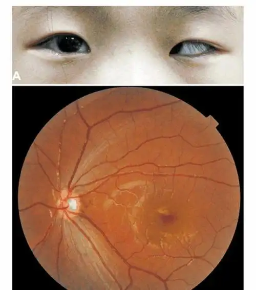 男孩常常玩手机,眼珠子渐渐地"消失",医生感叹:很难恢复