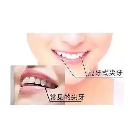 小时候虎牙萌,长大后它却害你越来越