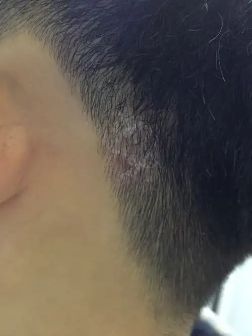 ps:后脑勺上长着东西有几年了,一开始没在意,容易痒