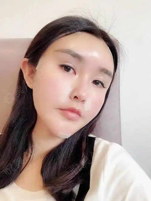 这次做自体脂肪填充就是想让脸显嫩一点