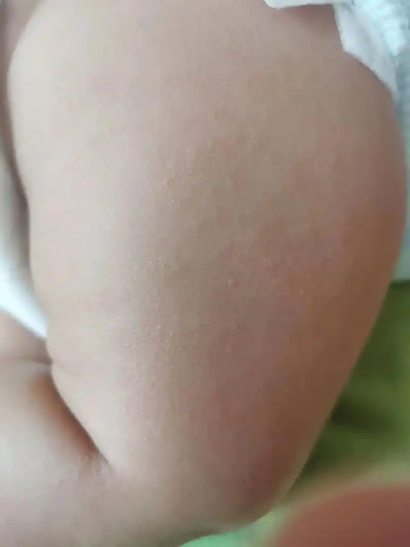 干性湿疹应该怎么护理的? 受不了了!脸上反反复复好不 - 抖音