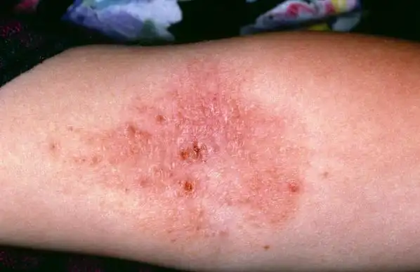 一种是渗液接触到别人的皮肤,使别人出现病毒性感染,引起湿疹