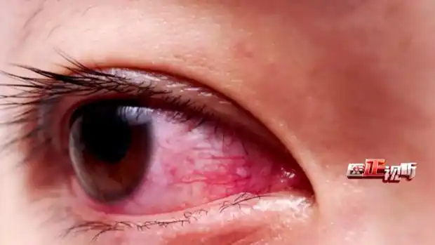 眼睛布满红血丝,你以为是缺觉吗?_新浪财经_新浪网