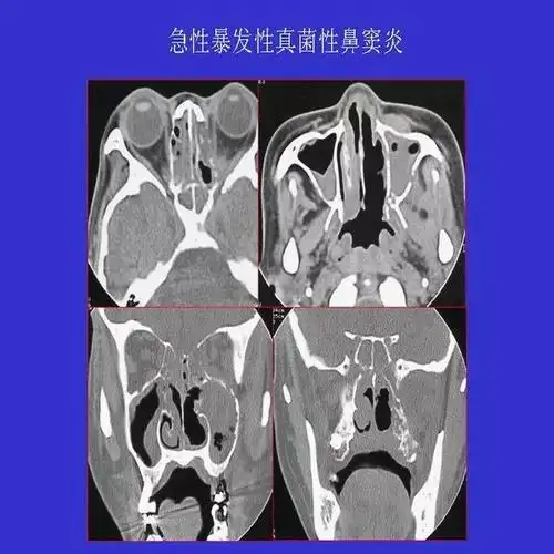 真菌性鼻窦炎影像学诊断
