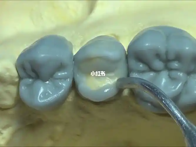 上颌第二前磨牙堆蜡