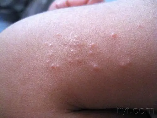 右上臂伸侧丘疹半月余个人考虑光泽苔藓