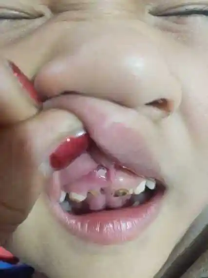 牙龈上的牙是怎么回事?孩子五周岁了