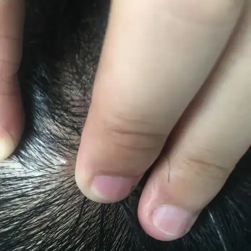 头皮有红色小疙瘩,有时会痒,结痂扣了有血;求解.