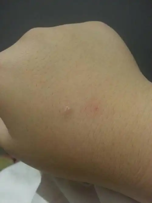 我的手上前几天突然出现了一个像蚊子咬的包,因为那段时间蚊子很多