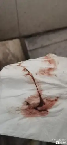 哪家好!着床成功出血图片"从它开始"-第2张图片-米兔博客