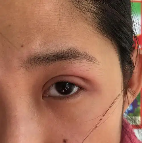 埋线双眼皮20天眼尾长个包,有点疼,问大夫他说是感染,让把脓挤出来就