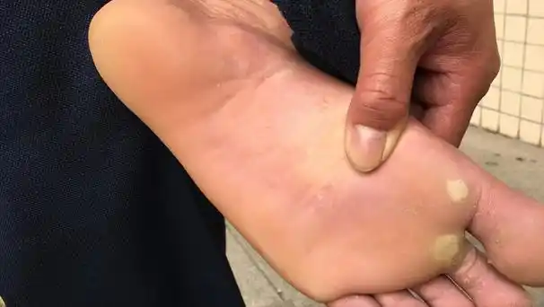 脚底板爱生茧子,走路疼怎么回事?