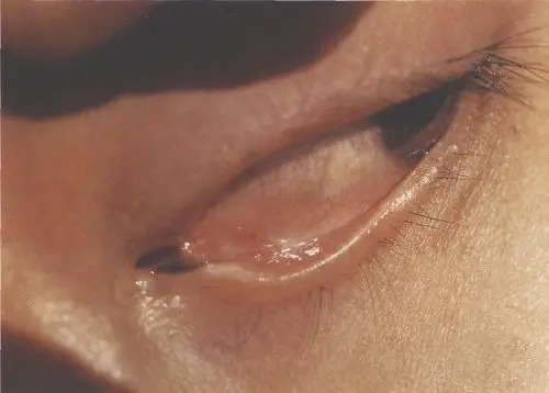 图213泪阜黑色素痣