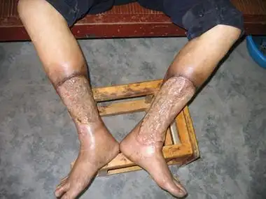 坏疽性臁疮可表现为患者两侧小腿有大片溃疡面,伤口处的皮下组织暴露