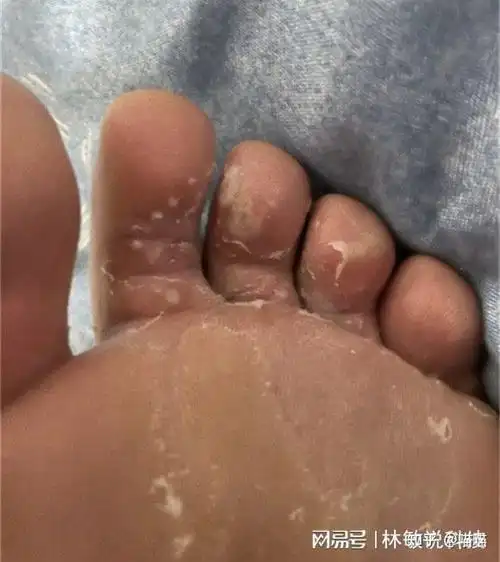 自愈者含泪分享治疗法,28天脚气去无踪 - 知乎