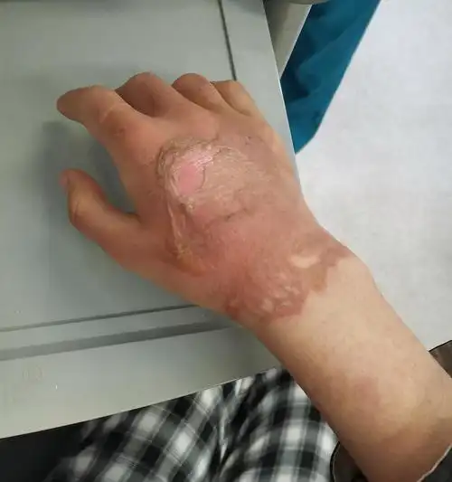 1112被热水烫伤记录恢复过程慎入之前发过继续更新