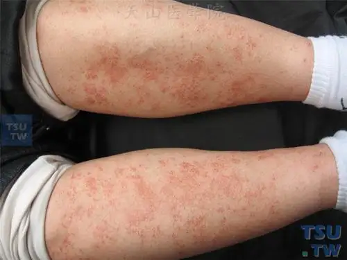 色素性紫癜性皮肤病的症状表现